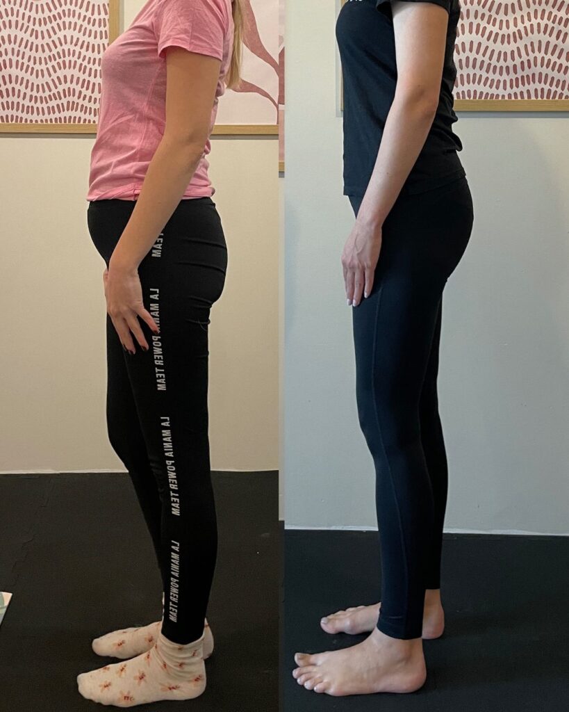 Metamorfoza Klientki - problem z rotacją wewnętrzną bioder